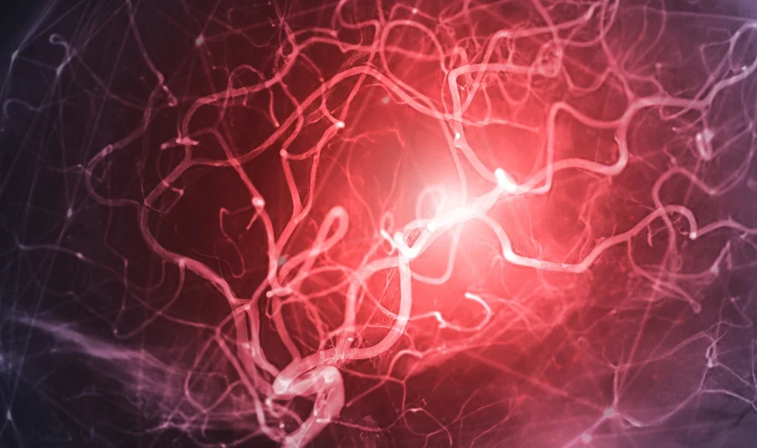 A fístula arteriovenosa pode formar um aneurisma?