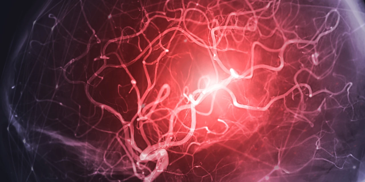 A fístula arteriovenosa pode formar um aneurisma?