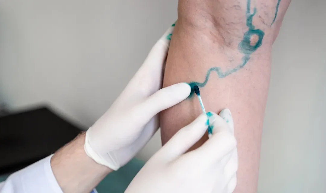 Acompanhamento de Cirurgião Vascular para fístula