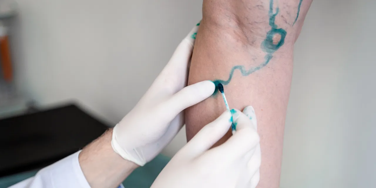 Acompanhamento de Cirurgião Vascular para fístula