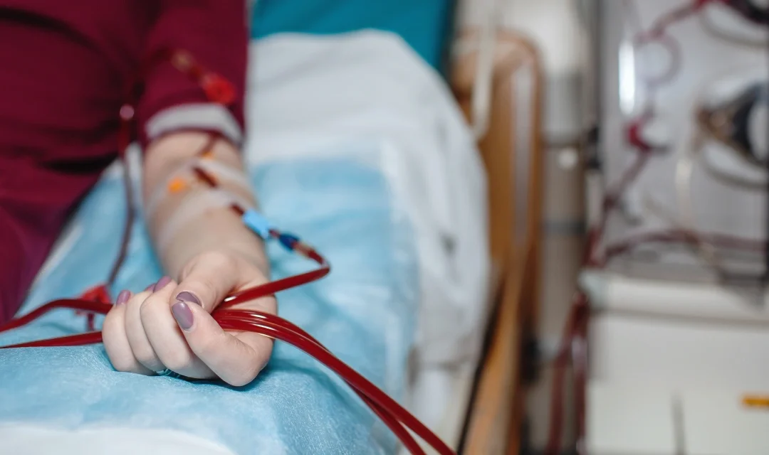 Tudo o que você precisa saber sobre fístula arteriovenosa para hemodiálise.